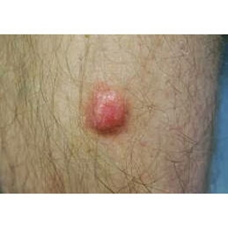 Dermatoinoma