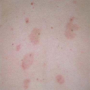 Meyerson-nevus