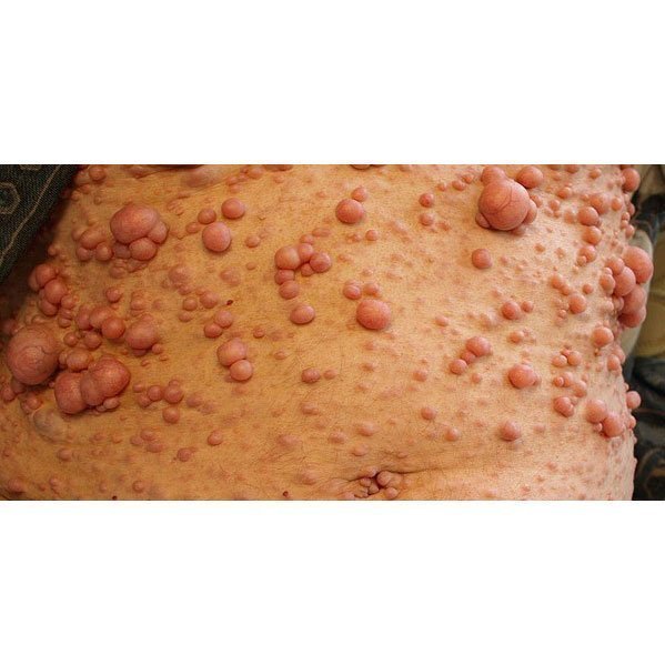 Neurofibromas-Von-Recklingh