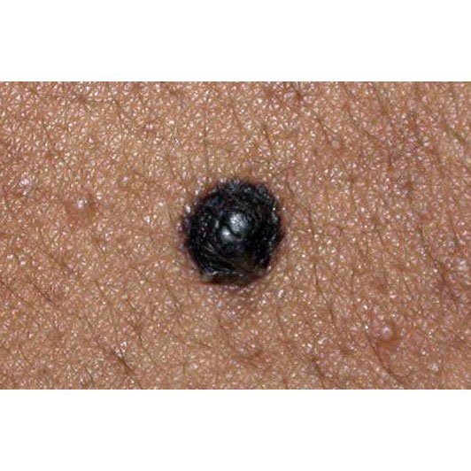 skouroxromo-derma